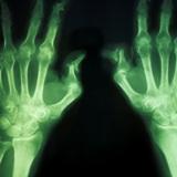 malattie reumatiche radiografia artrite reumatoide artrite psoriasica spondilite anchilosante