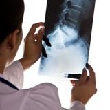 riserve di vitamina D osteoporosi ossa fratture densità minerale ossea sole inverno integrazione