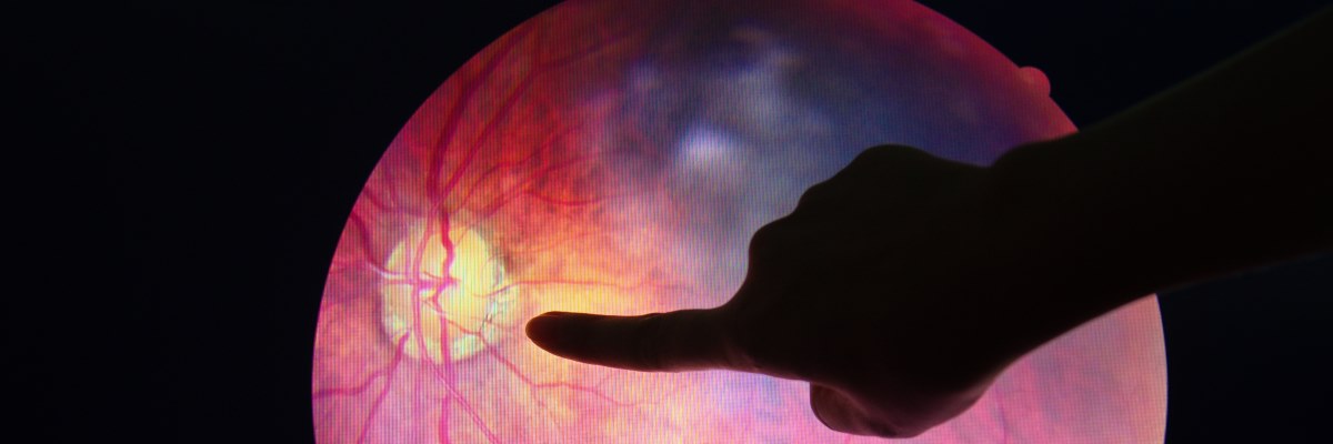 Edema maculare diabetico: una complicanza oculare da non sottovalutare