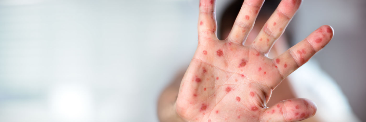 Allarme Morbillo, boom casi tra non vaccinati