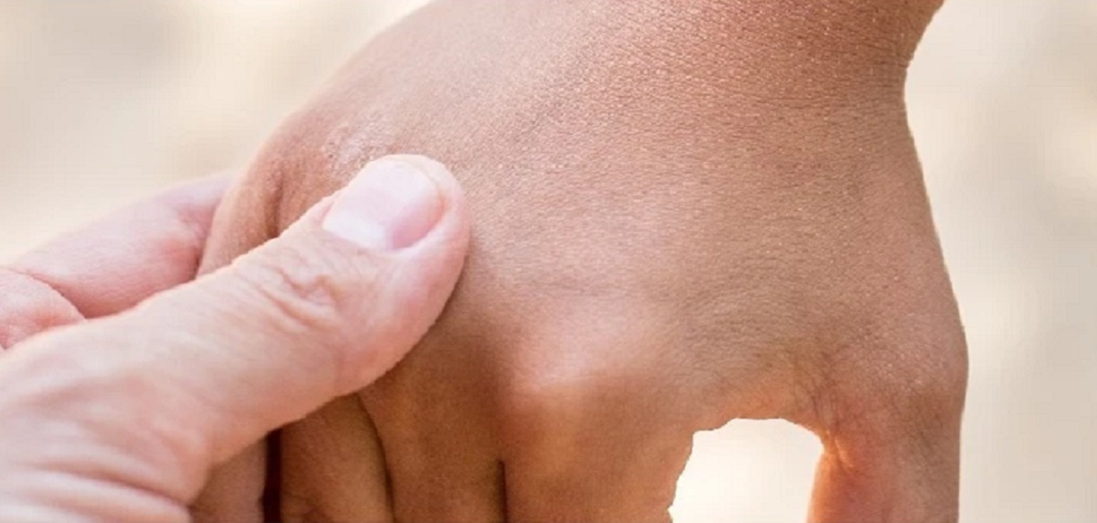 Scabbia, cure efficaci ma costose: ecco cosa sapere