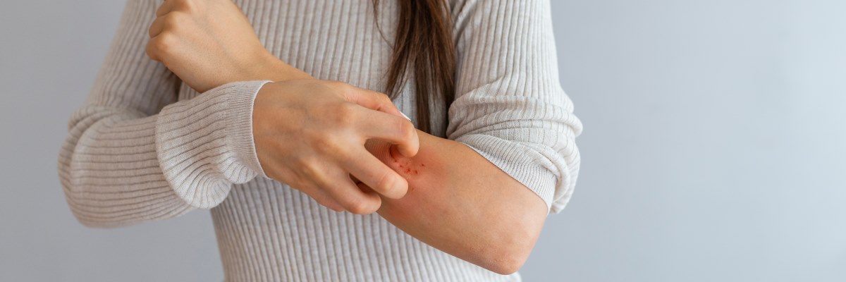 Coronavirus, tra i sintomi anche le manifestazioni cutanee