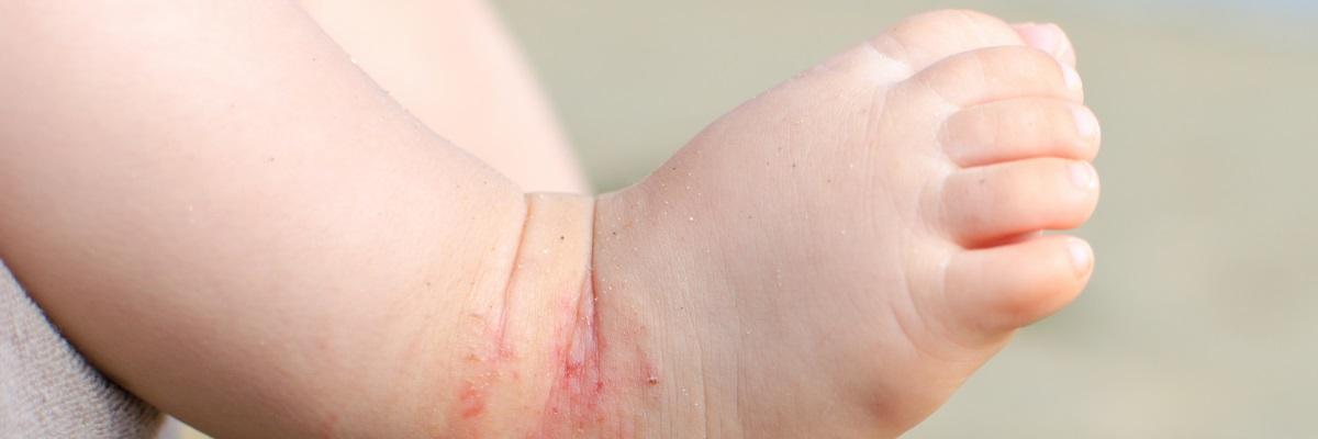 Eczema nei bambini: l’antibiotico non fa la differenza