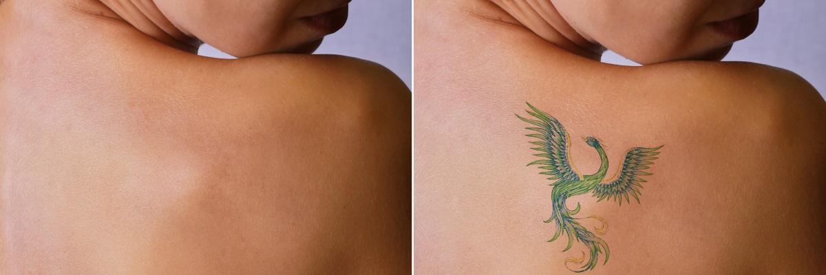 Tatuaggio: se cambio idea? Come rimuoverlo