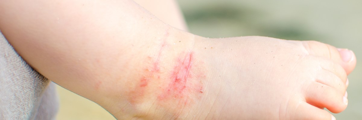 Dermatite atopica: parliamone per gestirla al meglio