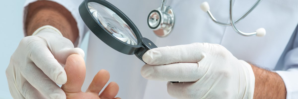 Micosi delle unghie dei piedi: cosa fare per combatterla