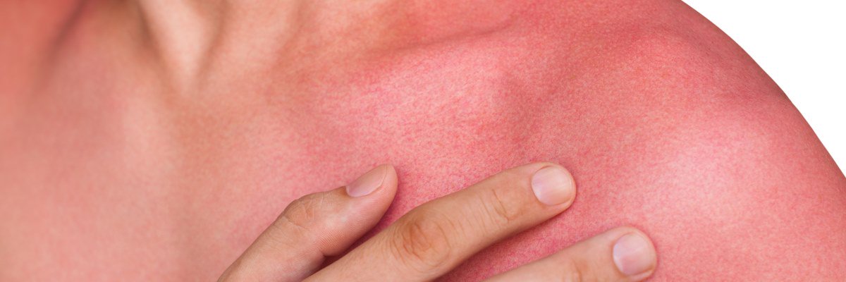 Eritema solare e scottature della pelle: come curarle e prevenirle