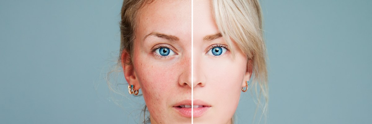 Rosacea, la malattia che 'infiamma' il viso: vuoi saperne di più?