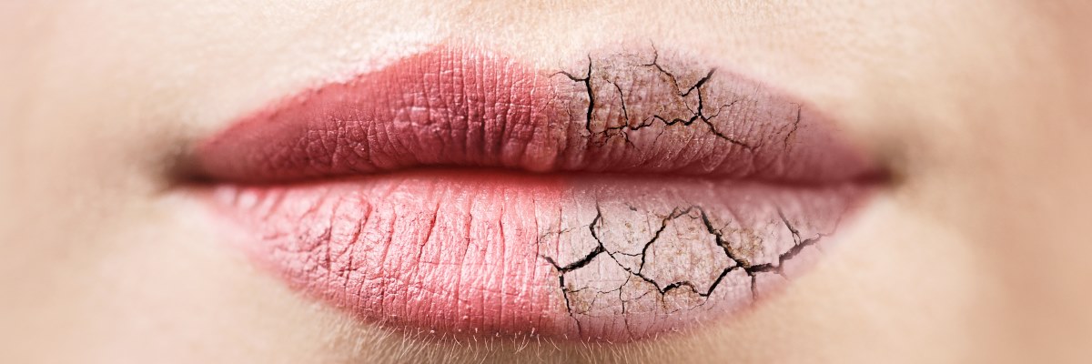 Allergia al freddo: sei consigli per proteggere la pelle