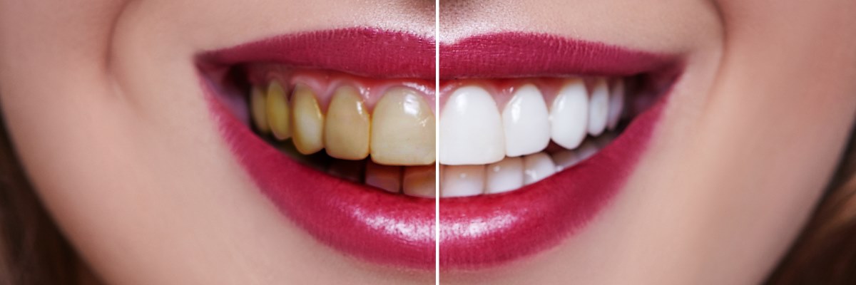 Fumo, caffè e farmaci alterano il colore dei denti