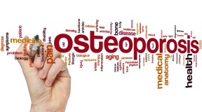 Osteoporosi: le tre cose che non sai