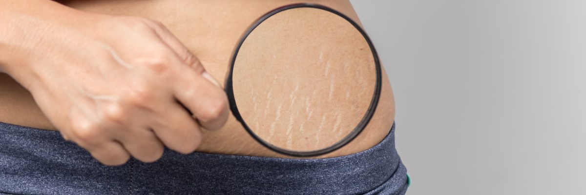 Smagliature: cause e prevenzione