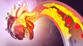 Colesterolo e rischio cardiovascolare 