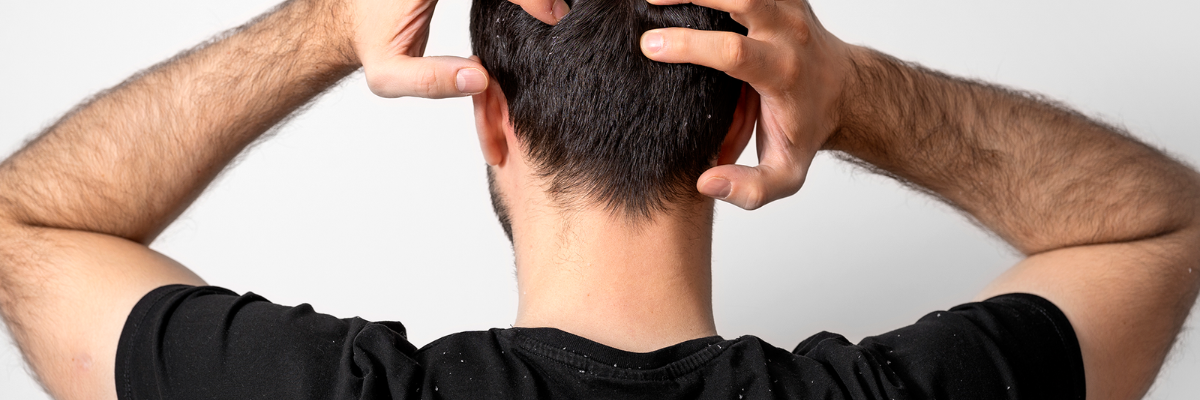 Capelli sani: abbasso la seborrea