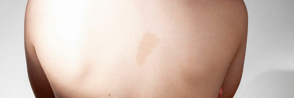 Neurofibromatosi, informare e informarsi: la voce di ANF