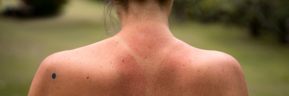 Nei e sole, le 10 regole dei dermatologi per proteggere la pelle