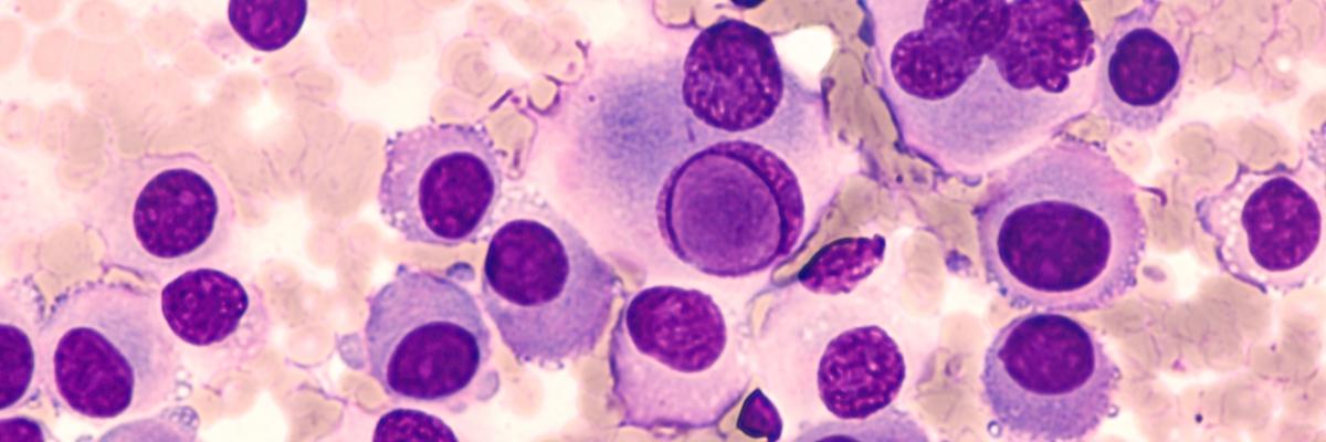 Sentinelle del melanoma