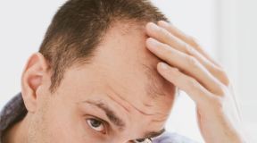 Alopecia: presentazione, cause e trattamento